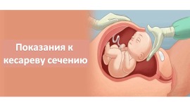 Показания к кесареву сечению